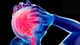 Epilepsia: qué es y cuáles son sus síntomas