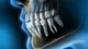 Implantes dentales sin miedo: Todo lo que tenés que saber