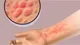 Alergias, intestino y emociones: lo que tu cuerpo te está diciendo