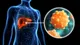 Hepatitis: cómo prevenirla y tratarla