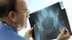 Osteoporosis: causas, detección precoz y hábitos para prevenirla