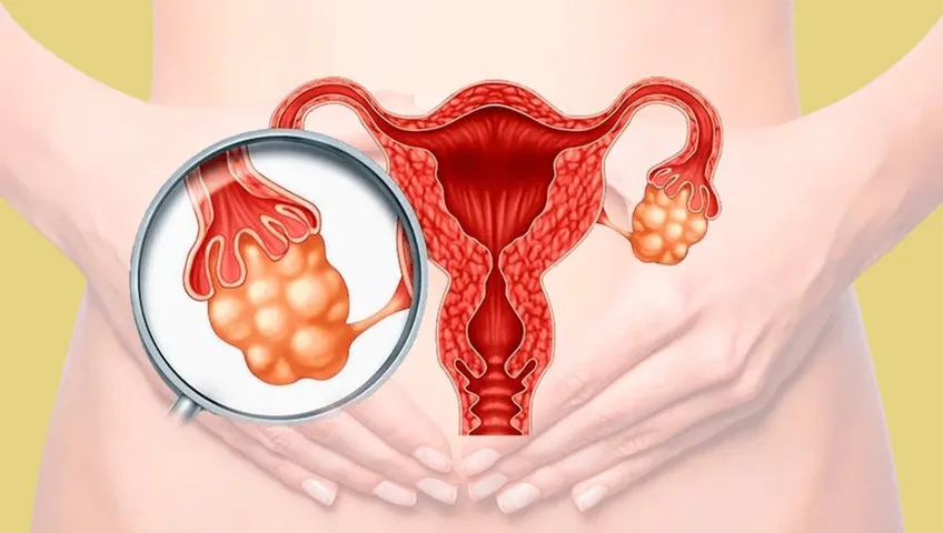 Síndrome del ovario poliquístico: ¿Qué es y cuáles son sus síntomas?